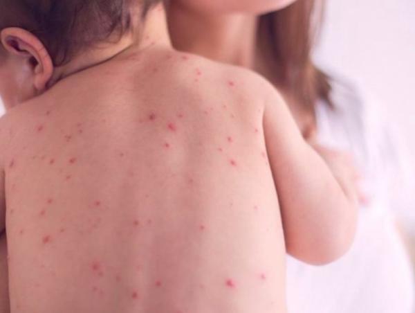 ХӨСҮТ: Улаанбурхан өвчний батлагдсан тохиолдол 1550 болжээ
