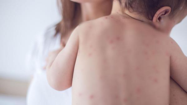 ХӨСҮТ: Улаанбурхан өвчний батлагдсан тохиолдол 6265 болжээ