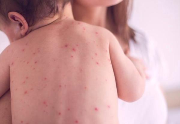 ХӨСҮТ: Улаанбурхан өвчнөөр гурван хүн хэвтэн эмчлүүлж байна